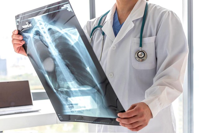 Trabalhador com tuberculose pode ter direito a benefícios previdenciários 1 Trabalhador com tuberculose pode ter direito a benefícios previdenciários