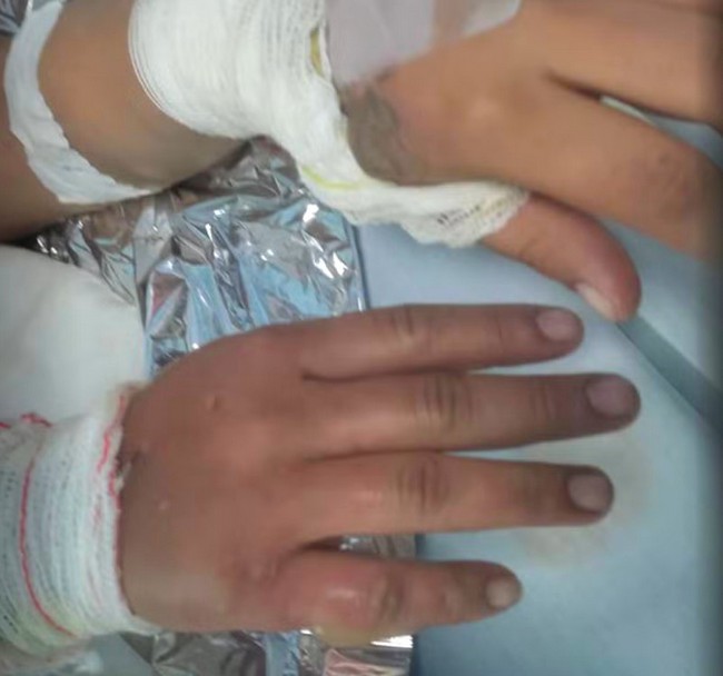 Homem preso em Sumaré por atear fogo na ex-namorada 1 Homem preso em Sumaré por atear fogo na ex-namorada